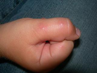 Neznámé malé pupínky na ručkách. Setkaly jste se s tím?