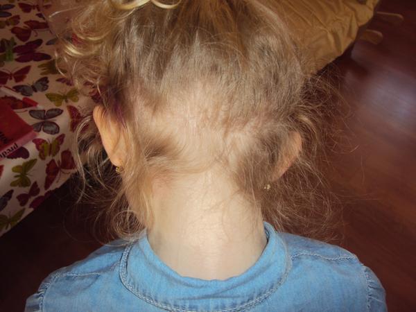 4-leté dceři padají vlasy - co na to?