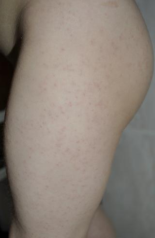 Máme vyrážku, jak na ni?