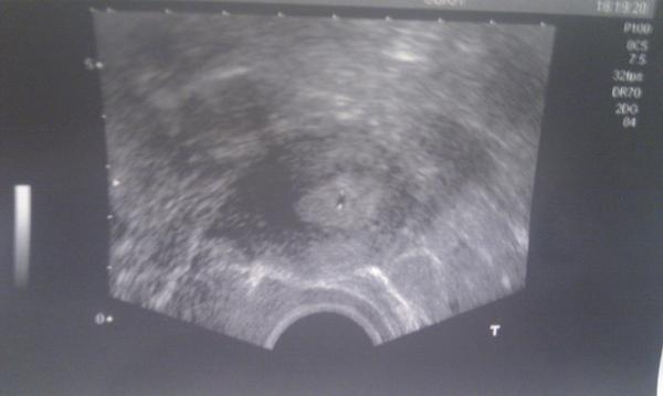 Řekl Vám doktor, že Váš gestační váček nemá ohraničení?