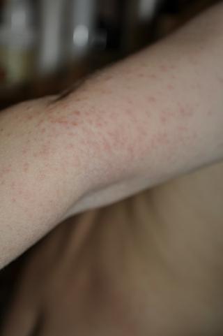 Máme vyrážku, jak na ni?