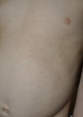 Máme vyrážku, jak na ni?