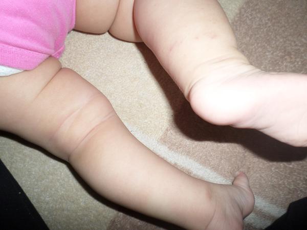 Podlitinky na nožičce, máte zkušenost?