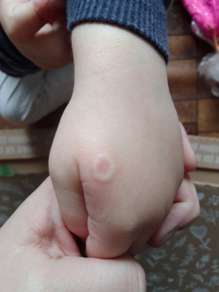 Zkušenosti s flíčky u dětí. Je to infekce?