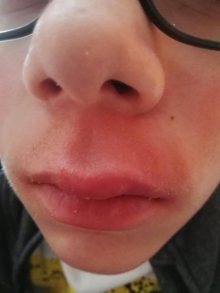 Zarudlá kůže pod nosem. Poradíte, prosím?