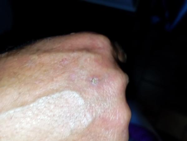 Kožní problém na hřbetu ruky a čele. Co to může být?