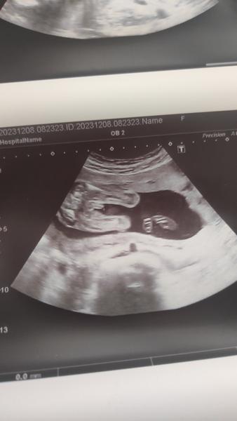 Poznáte z ultrazvuku pohlaví miminka?