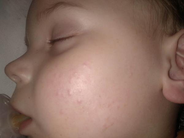 Pupínky na tvářích a na těle. Co by to mohlo být?