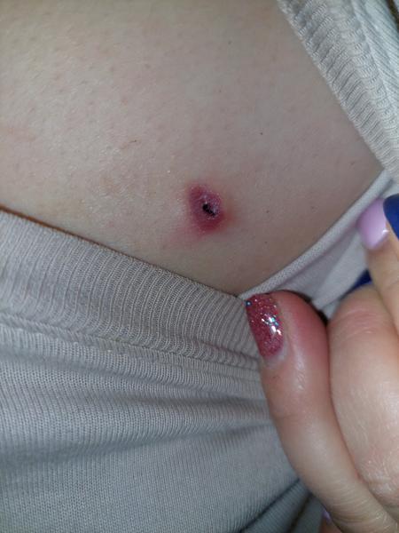 Je normální, že rána po implantaci EKG záznamníku je bolestivá?