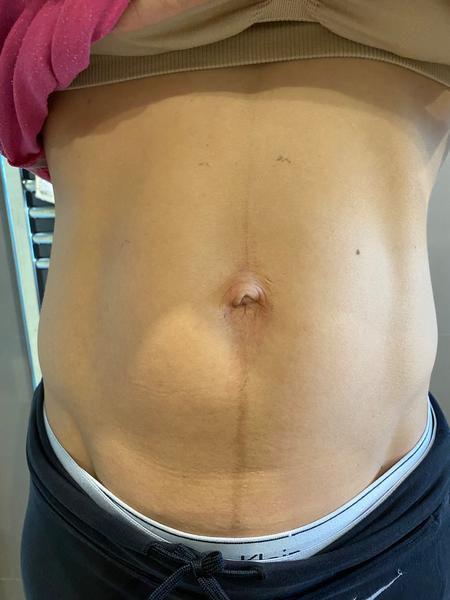 Divný pupek po porodu. Je to kýla?