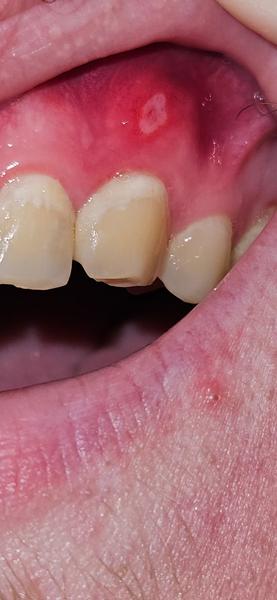 Co znamená bílé nad zubem a proč to štípe?