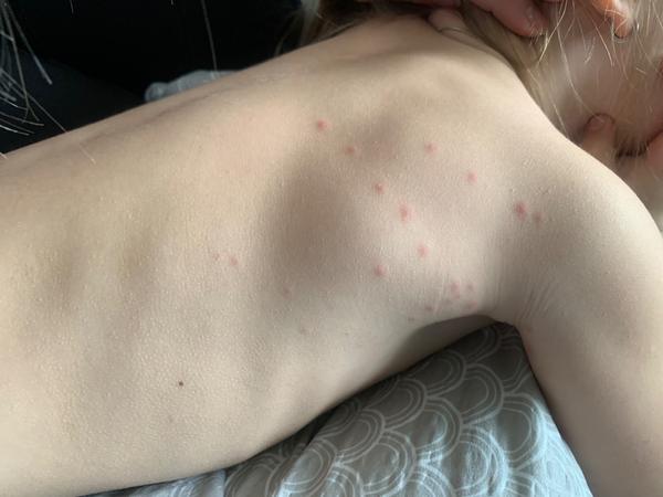 Jsou pupínky u dcery příznakem neštovic?