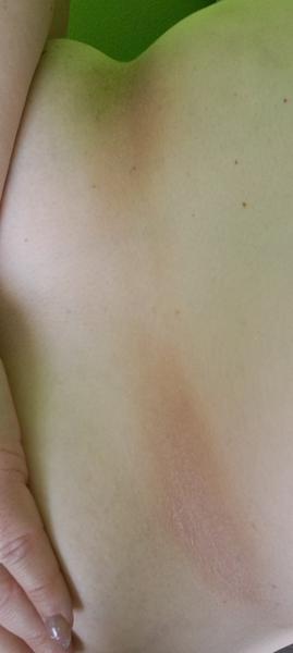 Jak se zbavit suchých fleků pod prsy?