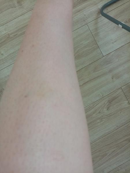 Modřiny na dolních končetinách - z čeho můžou být?