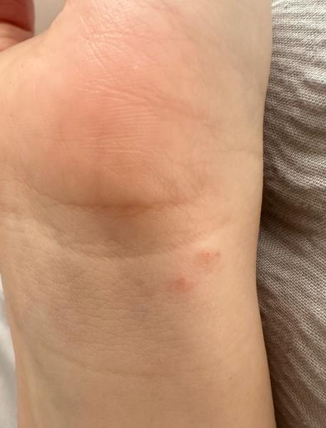 Svědivé puchýřky na těle. Je to svrab nebo alergie?