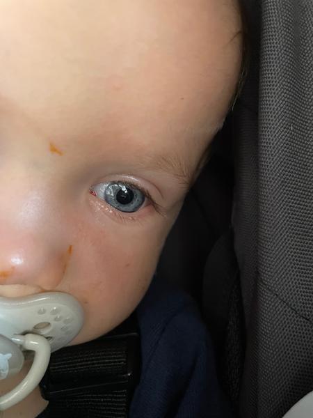 Co dělat při objevení krve v oku u dítěte?