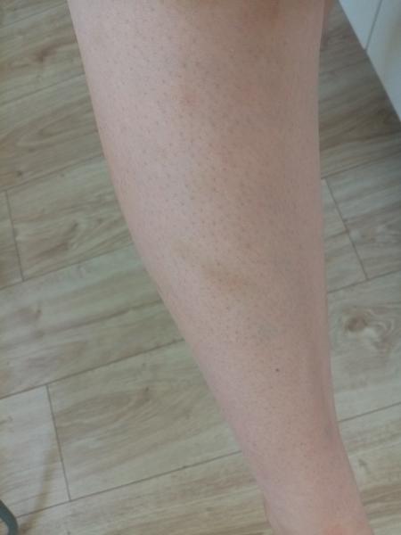 Modřiny na dolních končetinách - z čeho můžou být?