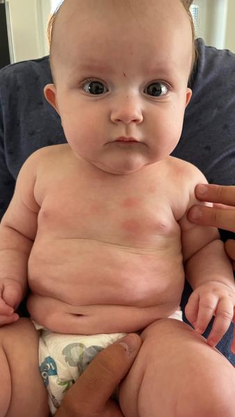 Červené fleky s bílým vnitřkem. Nemůže to mít souvislost s komplikacemi po porodu?