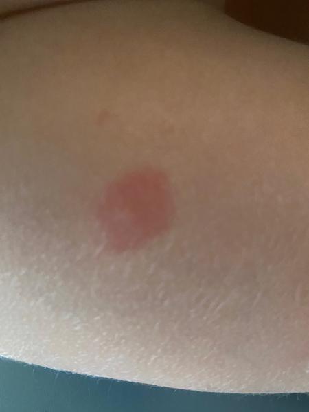 Červené fleky na kůži dítěte. Co to může být?