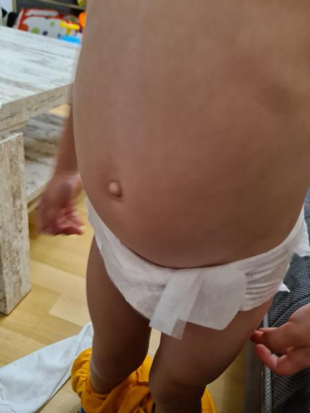 Jak rozpoznat pupeční kýlu? Podívejte se na příznaky.