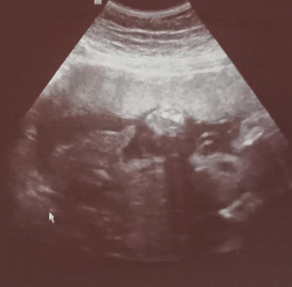 Jak poznat pohlaví z ultrazvuku ve 26. týdnu?