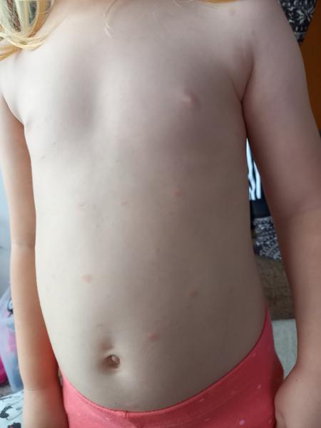 Fleky na těle u dcery. Co může být příčinou?