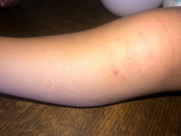 Vyrážka na kolenou a loktech dítěte po návratu z Tuniska?