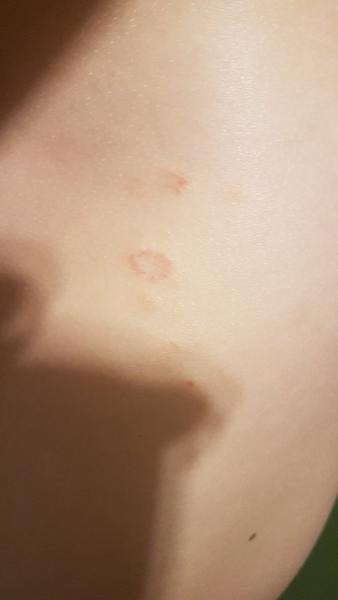 Jak rozpoznat vyrážku u dítěte? Pomoc rodičům.