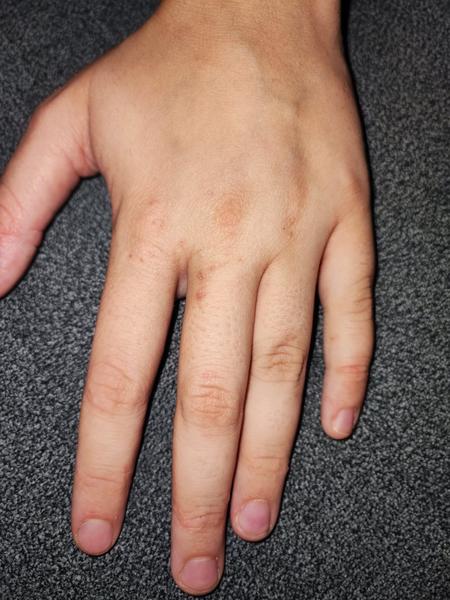 Pupínky a svědění celé rodiny. Je to svrab nebo ekzém?