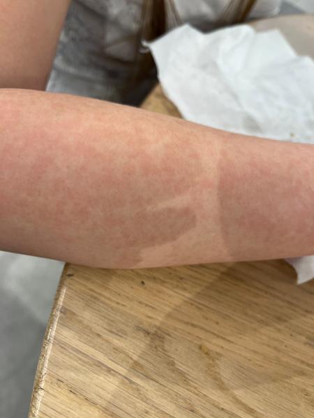 Alergie na sluníčko nebo pátá nemoc u dětí?