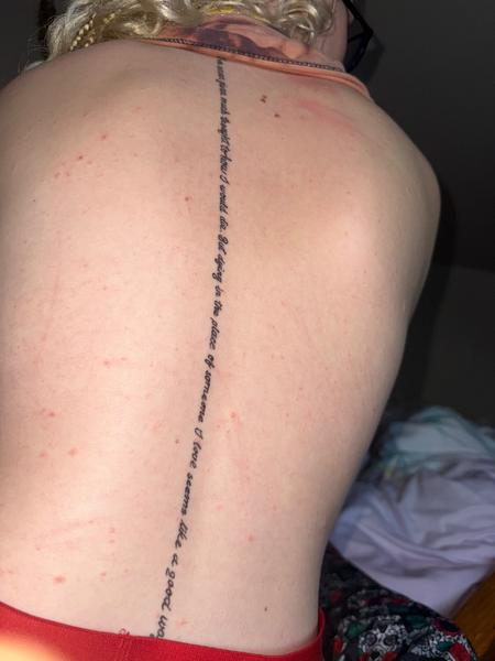 Svědivé pupínky na těle. Jsou to symptomy svrabu?