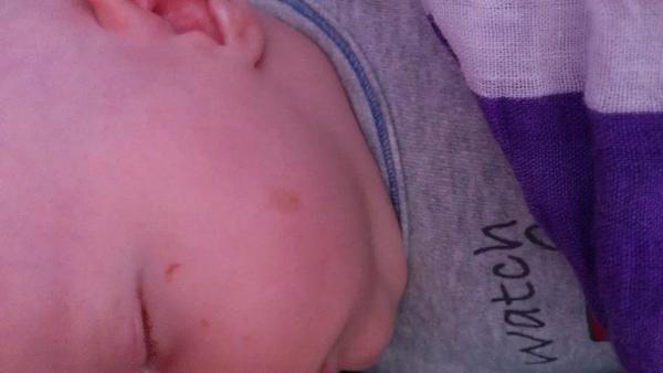 Flíček na tvářičce, co to může být?