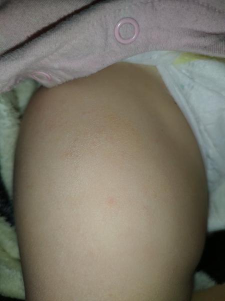 Lepek způsobuje znovu se objevující flíčky u dětí?