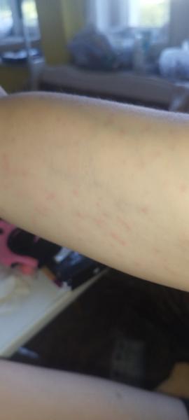 Vyrážka. Co by pomohlo?