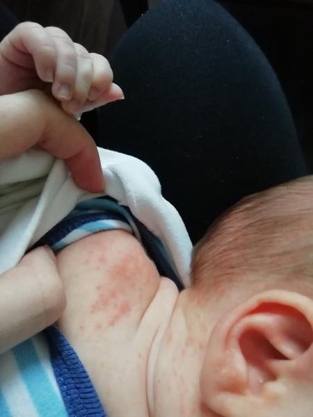Vyrážka v obličeji u miminka. Co by to mohlo být?