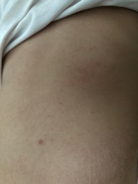 Ekzém, potničky, nebo zapařenina. Co myslíte?