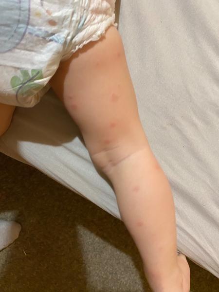 Vyrážka u dítěte: Jakou nemoc může způsobovat?