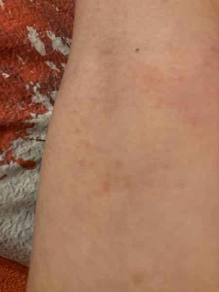 Je to vyrážka pod kolenem nebo svrab?