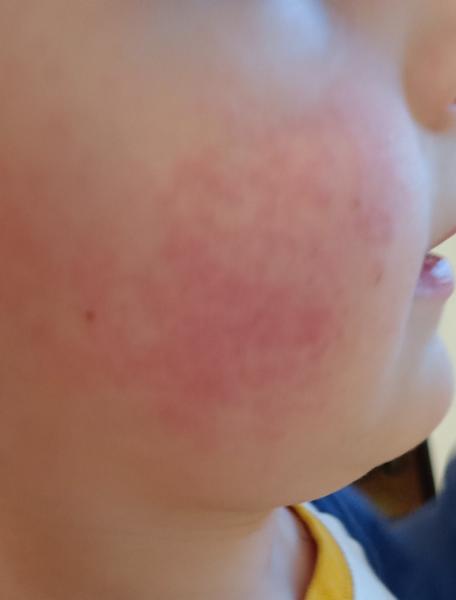 Vyrážka u čtyřletého dítěte: možné příčiny?