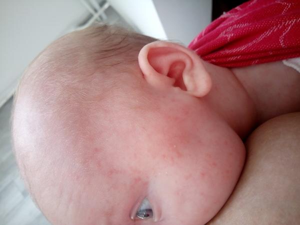 Vyrážky na tváři, co to je?