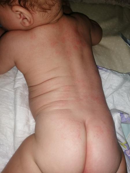 Ekzém vyrážka. Co by to mohlo být?