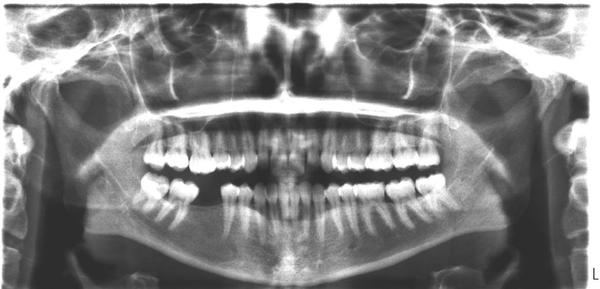 Je uvnitř dásně uzlina? Zkušenosti a rady.