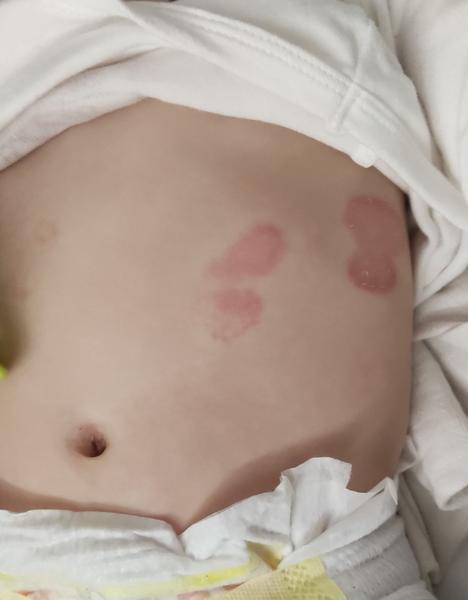 Ekzém u miminka. Jak poznat a léčit vyrážku?