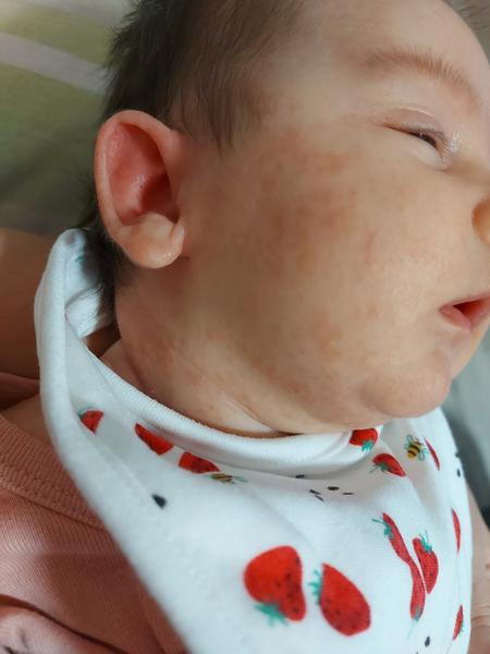 Kdy mizí ekzém u alergie na bílkovinu kravského mléka?