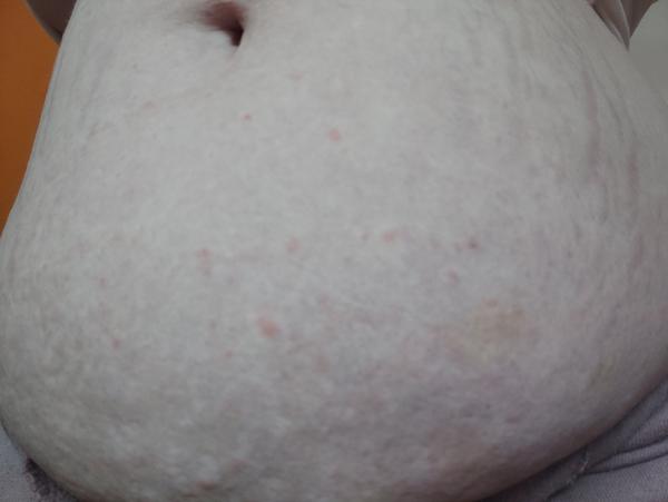 Co způsobuje vyrážku na stehnech a břichu?