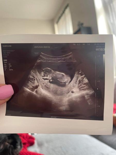 Tekutina kolem plodu v těhotenství. Jaké máte zkušenosti?