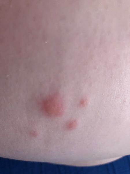 Pupínky na bedrech - předcházelo svědění