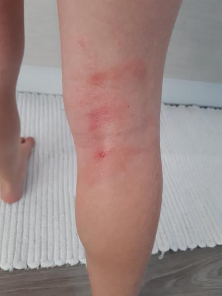 Pupínky na noze u dcery. Co to může být?