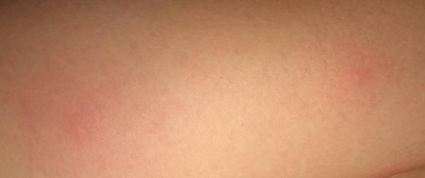 Záhadné pupínky. Co by to mohlo být?