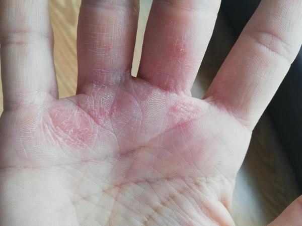 Dyshidrotický ekzém. Jedná se o tento typ ekzému? Jak se ho zbavit?